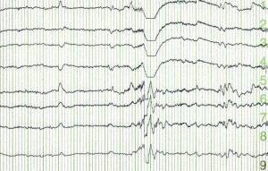EEG epilepsi